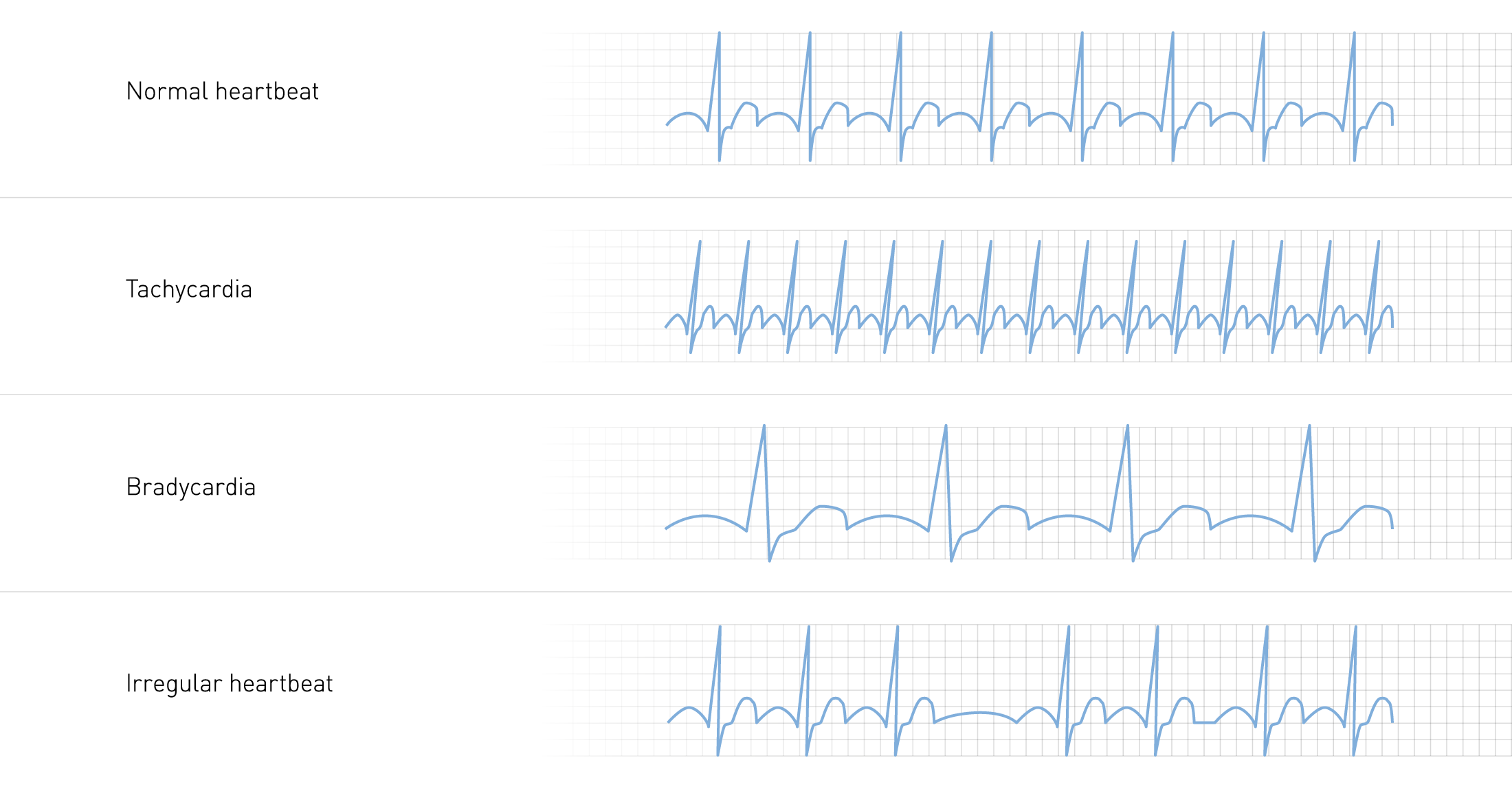 Postural Orthostatic Tachycardia Syndrome - A POTS Primer for